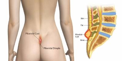 Pilonidal Cyst (sinus)